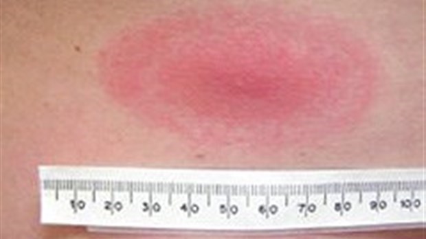 Rappel de santé publique : maladie de Lyme 