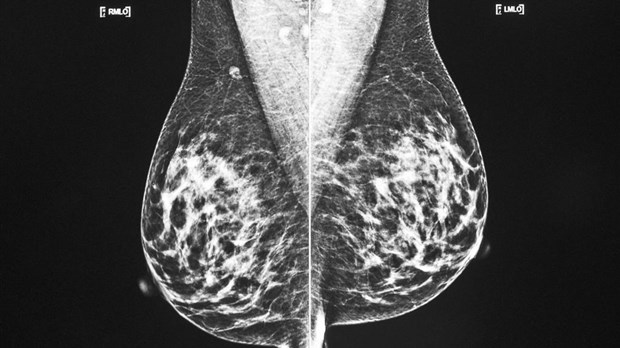 Une étude détaille l'association entre l'obésité et le cancer du sein