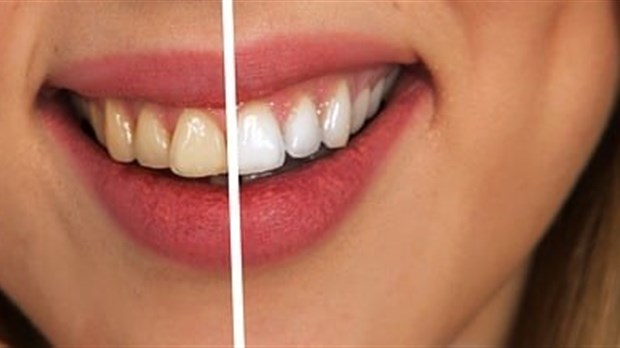 Tout ce qu’il faut savoir sur la pose de facettes dentaires