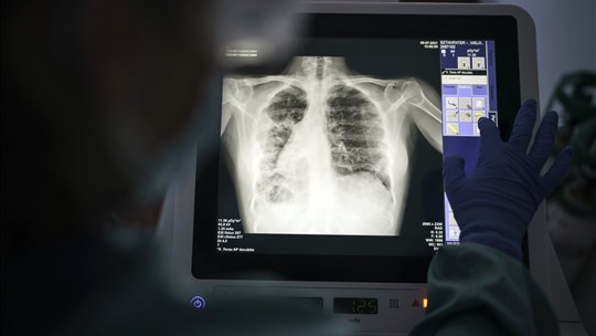 Le retour de maladies infectieuses de jadis qui étaient presque disparues au Canada